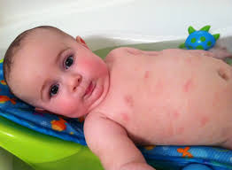 Berbagai Macam Alergi Dan Pemicunya Pada Anak-Anak